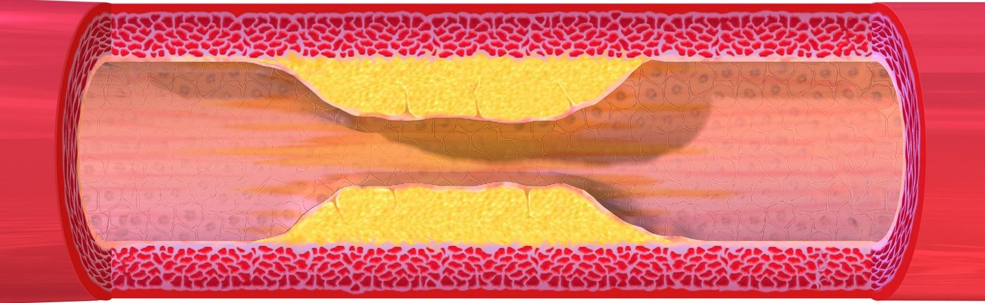 Cutaway illustration of an artery narrowed by yellow plaque along both walls